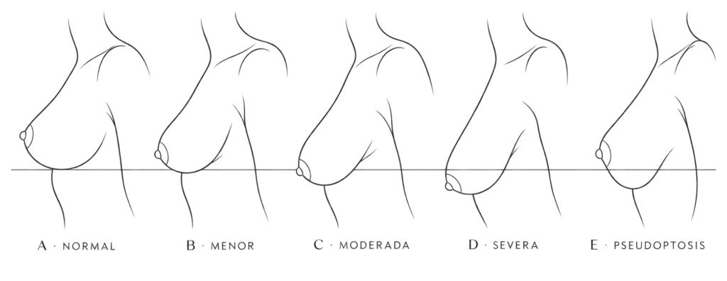 Mastopexia con o sin prótesis: cómo saber cuál necesitas Mastopexia con o sin prótesis: cómo saber cuál necesitas